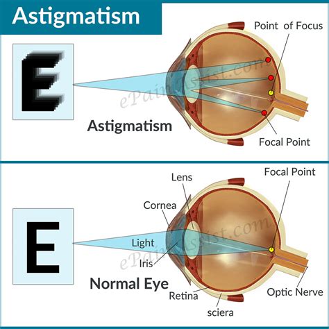 Astigmatism .